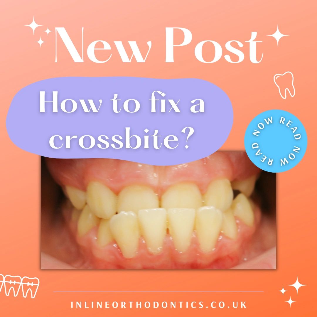 How to Fix a Crossbite